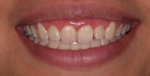 Sonrisa Gingival